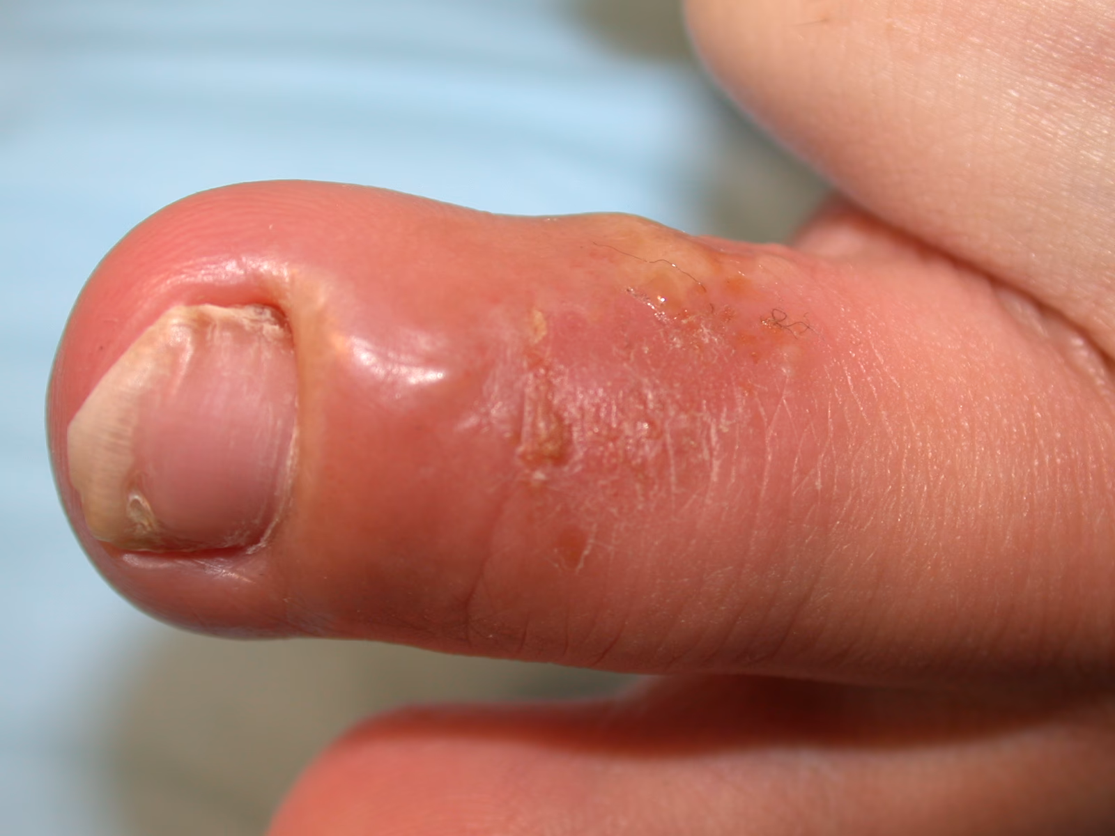 Hvordan kan man få en splint ud af fingeren?