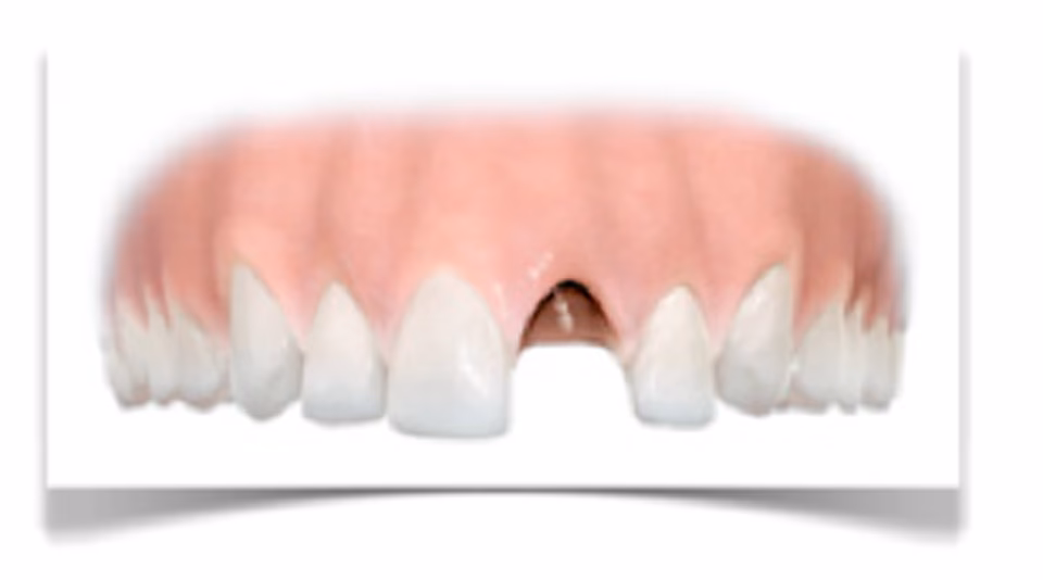 Hvad er metalimplantater?