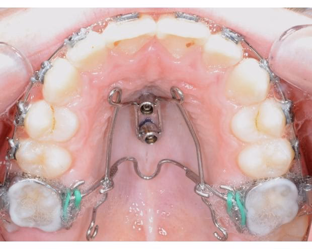 Hvad koster det at få implantater i hele munden?